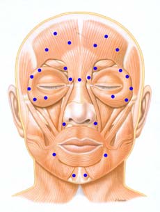 Foto de
uma imagem desenvolvida pela da Allergan, Inc. de um rosto com v?rios 
pontos onde se aplica a toxina botul?nica tipo A