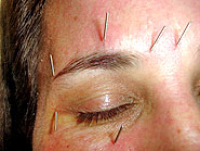 Foto de 
acupuntura facial